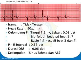 Basic Cardiac Life Support
GADAR Medik Indonesia
 Irama : Tidak Teratur
 Heart Rate : 90x/mnt
 Gelombang P : Tinggi 1.5mv, Lebar : 0,08 det
 Morfologi beda pd beat 2 ,7
 Rasio 1:1 kecuali beat 2 dan 7
 P – R Interval : 0.16 det
 Durasi QRS : 0.06 det
 Kesimpulan Sinus Rthme dan AES
 