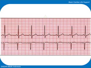 Basic Cardiac Life Support
GADAR Medik Indonesia
 