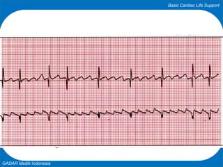 Basic Cardiac Life Support
GADAR Medik Indonesia
 