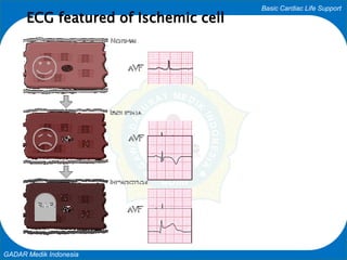 Basic Cardiac Life Support
GADAR Medik Indonesia
ECG featured of Ischemic cell
 