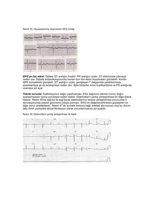 Resim 45. Hipopotasemiyi düşündüren EKG örneği




EKG’ye ilaç etkisi: Dijitalis QT aralığını kısaltır, PR aralığını uzatı...