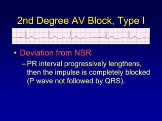 2nd Degree AV Block, Type I


• Deviation from NSR
  – PR interval progressively lengthens,
    then the impulse is completely blocked
    (P wave not followed by QRS).
 