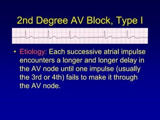 2nd Degree AV Block, Type I


• Etiology: Each successive atrial impulse
  encounters a longer and longer delay in
  the AV node until one impulse (usually
  the 3rd or 4th) fails to make it through
  the AV node.
 