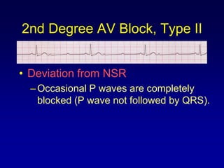 2nd Degree AV Block, Type II


• Deviation from NSR
  – Occasional P waves are completely
    blocked (P wave not followed by QRS).
 