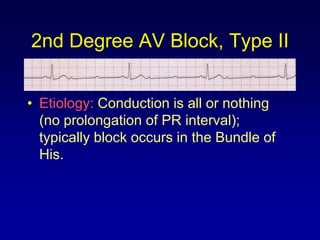 2nd Degree AV Block, Type II


• Etiology: Conduction is all or nothing
  (no prolongation of PR interval);
  typically block occurs in the Bundle of
  His.
 