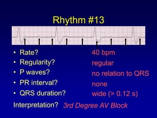 Rhythm #13


•   Rate?               40 bpm
•   Regularity?         regular
•   P waves?            no relation to QRS
•   PR interval?        none
•   QRS duration?       wide (> 0.12 s)
Interpretation? 3rd Degree AV Block
 