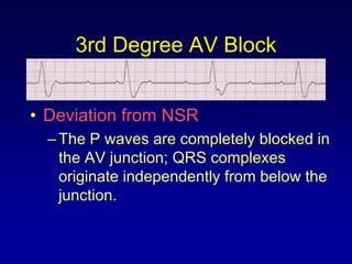3rd Degree AV Block


• Deviation from NSR
  – The P waves are completely blocked in
    the AV junction; QRS complexes
    originate independently from below the
    junction.
 