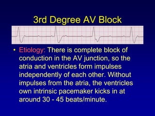 3rd Degree AV Block


• Etiology: There is complete block of
  conduction in the AV junction, so the
  atria and ventricles form impulses
  independently of each other. Without
  impulses from the atria, the ventricles
  own intrinsic pacemaker kicks in at
  around 30 - 45 beats/minute.
 