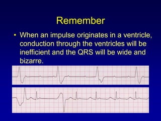 Remember
• When an impulse originates in a ventricle,
  conduction through the ventricles will be
  inefficient and the QRS will be wide and
  bizarre.
 