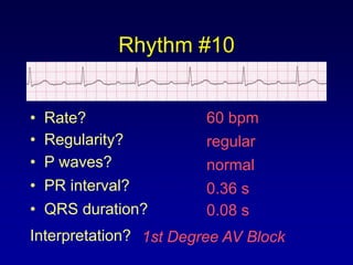 Rhythm #10


•   Rate?               60 bpm
•   Regularity?         regular
•   P waves?            normal
•   PR interval?        0.36 s
•   QRS duration?       0.08 s
Interpretation? 1st Degree AV Block
 