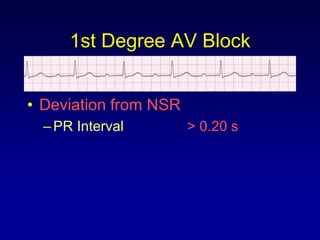 1st Degree AV Block


• Deviation from NSR
  – PR Interval        > 0.20 s
 