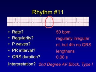 Rhythm #11


•   Rate?               50 bpm
•   Regularity?         regularly irregular
•   P waves?            nl, but 4th no QRS
•   PR interval?        lengthens
•   QRS duration?       0.08 s
Interpretation? 2nd Degree AV Block, Type I
 