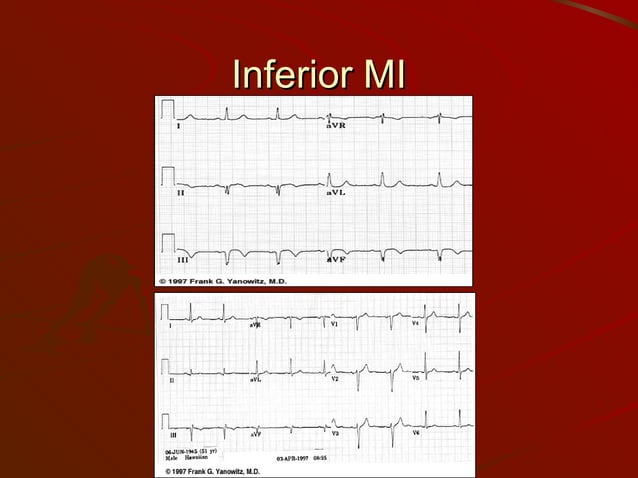 ekg-myocardial-infarction-ischemic-states-ppt