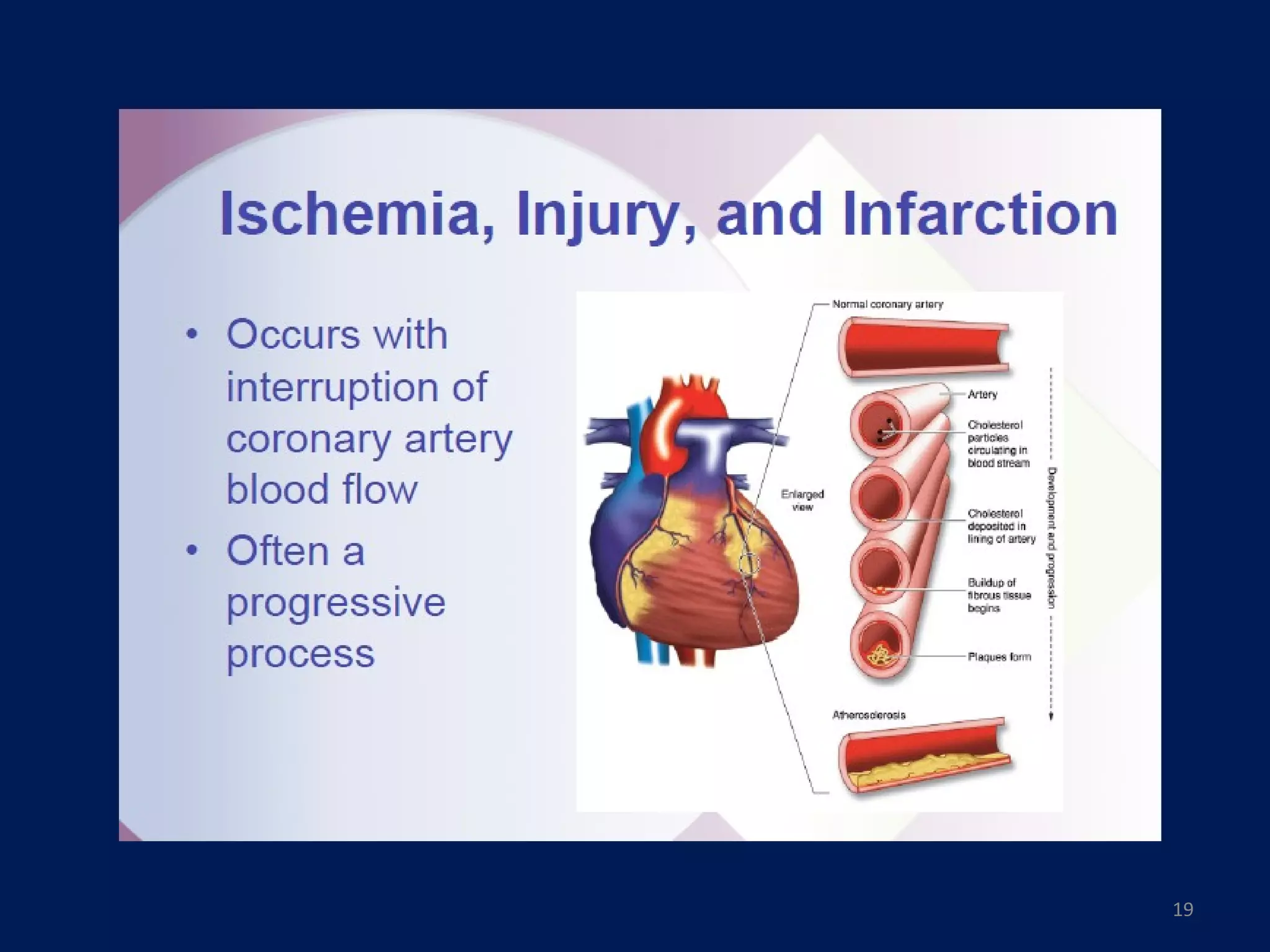 Ekg myocardial ischemia & Infarction | PPT