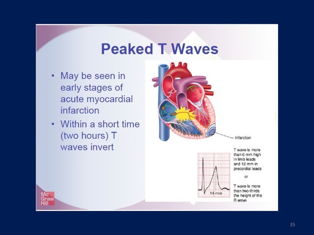 Ekg myocardial ischemia & Infarction | PPT