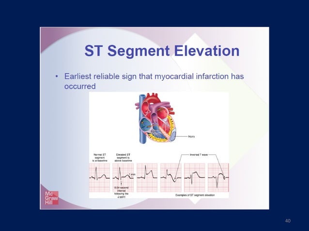 Ekg myocardial ischemia & Infarction | PPT