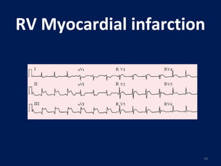 Preload Effected Rv Infarct Ekg myocardial ischemia & Infarction | PPT