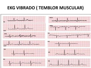 ¿Dónde se deben aplicar los electrodos en los brazos?Hay dos posibilidades:La más usada es en la parte anterior del antebrazo (esta zona tiene menos vello que el dorso del antebrazo). 