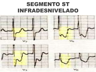 Rutina de interpretación del ECG de superficieSe debe hacer un análisis de 10 aspectos:LOS 10 MANDAMIENTOSRitmo.Frecuencia cardiaca.Onda P.Intervalo PR.Intervalo QRS.Complejo QRS.Segmento ST.Onda T.Onda U.Intervalo QT.