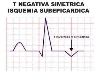 CAUSAS DE INFRADESNIVEL DEL SEGMENTO ST:-Lesión subendocárdicaFármacos (digoxina, diuréticos) Hipokalemia