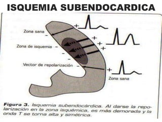 ECG de niño normal de 5 años, con T (-) en V1-2-3