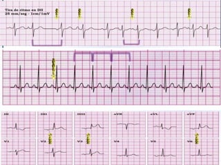 ONDAS-SEGMENTOS-INTERVALOS