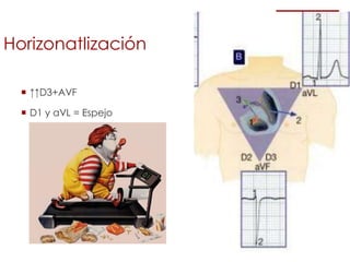 Horizonatlización
 ↑↑D3+AVF
 D1 y aVL = Espejo
 