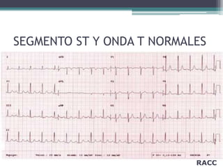 RACC
SEGMENTO ST Y ONDA T NORMALES
 
