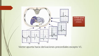Vector apunta hacia derivaciones precordiales excepto V1.
Voltaje igual
o menor a
2.5mm.
 