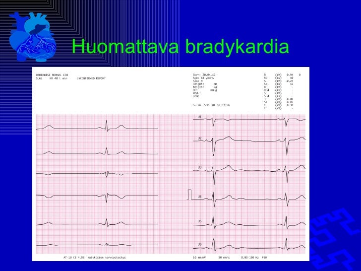 Mik On Ekg N Tulkinta EKG Kertoo Syd mesi Rytmin KNAD Mik On Ekg N Tulkinta EKG Kertoo Syd mesi Rytmin KNAD