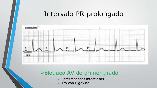 intervalo pr electrocardiograma