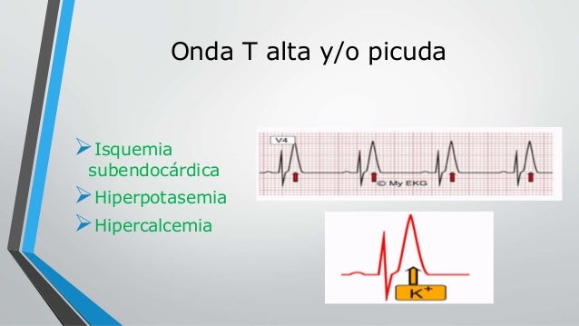 Ekg patologico