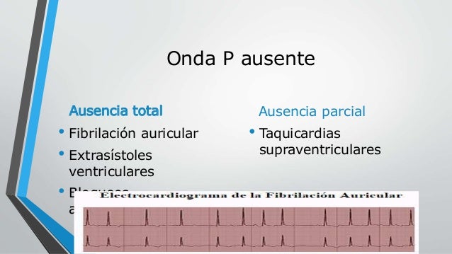 Fibrilacion Auricular Ausencia De Onda P