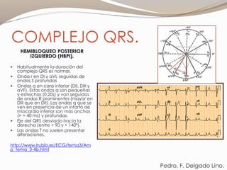 COMPLEJO QRS.
HEMIBLOQUEO POSTERIOR
IZQUIERDO (HBPI).
 Habitualmente la duración del
complejo QRS es normal.
 Onda r en DI y aVL seguidas de
ondas S profundas
 Ondas q en cara inferior (DII, DIII y
aVF). Estas ondas q son pequeñas
y estrechas (0,20s) y van seguidas
de ondas R prominentes (mayor en
DIII que en DII). Las ondas q que se
ven en presencia de un infarto de
miocardio inferior son más anchas
(> = 40 ms) y profundas.
 Eje del QRS desviado hacia la
derecha (entre + 90 y + 140º).
 Las ondas T no suelen presentar
alteraciones.
http://www.lrubio.es/ECG/tema3/Am
p_tema_3-4b.html
Pedro. F. Delgado Lino.
 