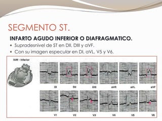 SEGMENTO ST.
INFARTO AGUDO INFERIOR O DIAFRAGMATICO.
 Supradesnivel de ST en DII, DIII y aVF.
 Con su imagen especular en DI, aVL, V5 y V6.
 