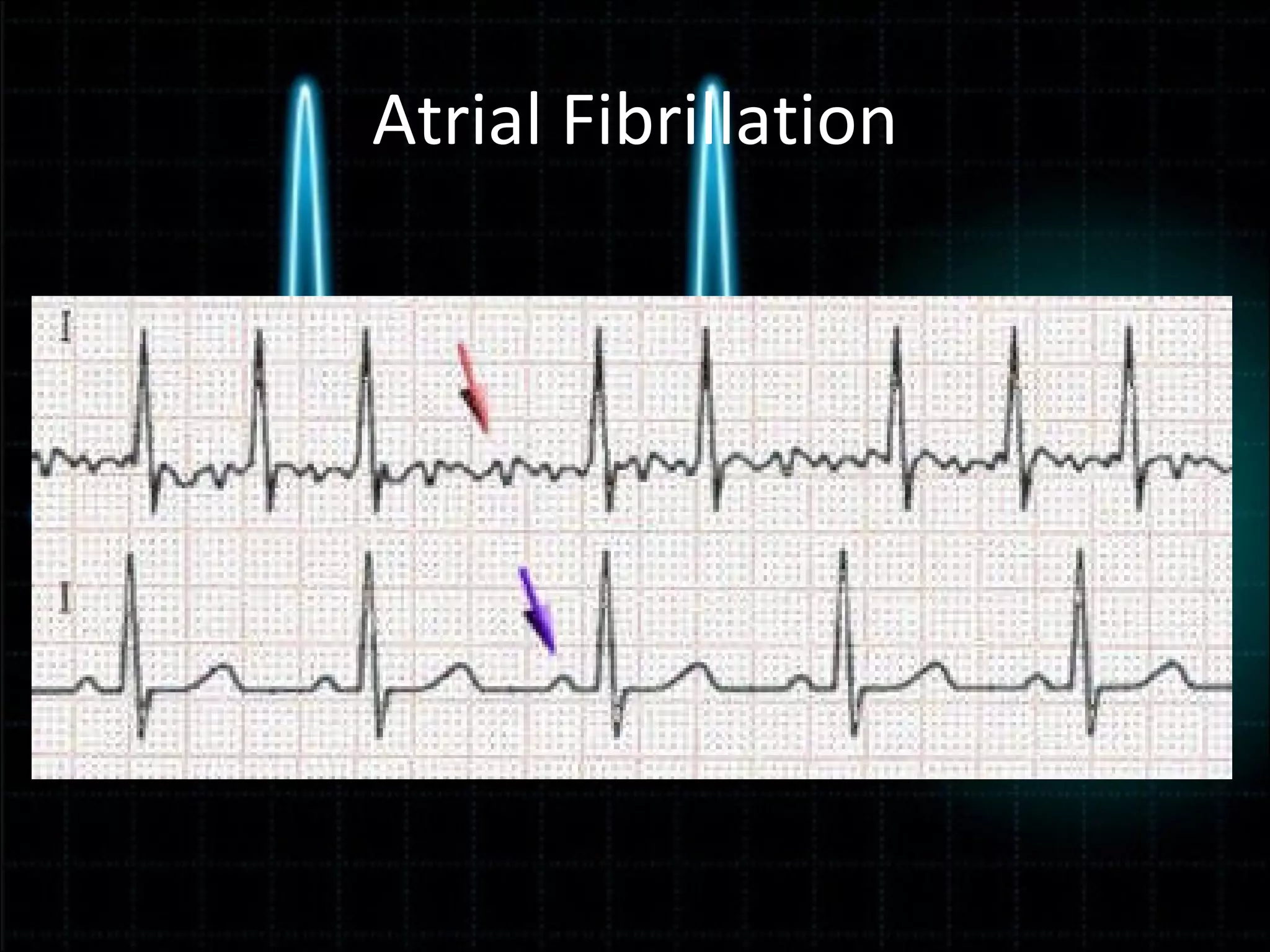 Ekg powerpoint | PPT