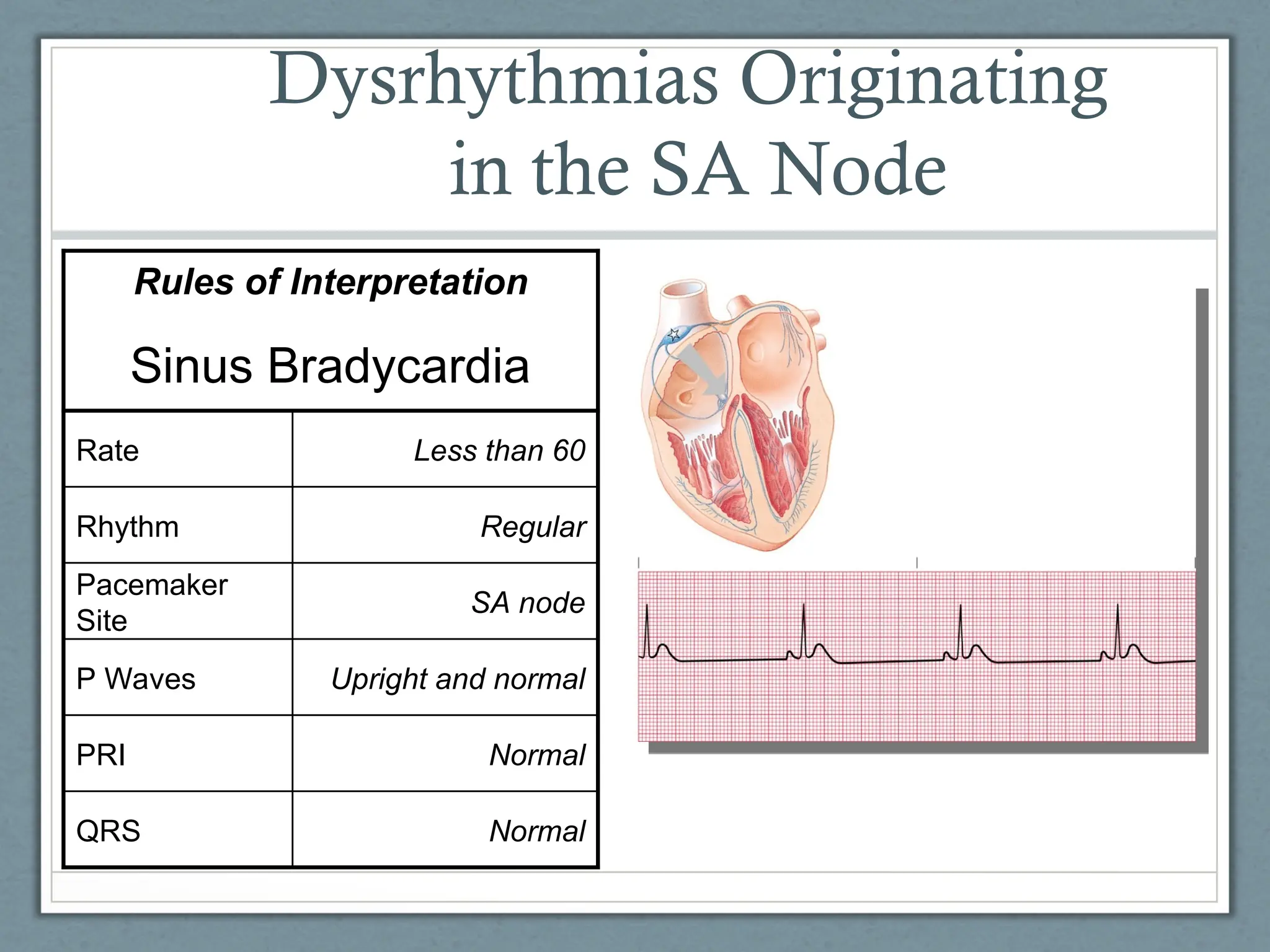 Dysrhythmias Originating
in the SA Node
Normal
QRS
Normal
PRI
Upright and normal
P Waves
SA node
Pacemaker
Site
Regular
Rhythm
Less than 60
Rate
Sinus Bradycardia
Rules of Interpretation
 