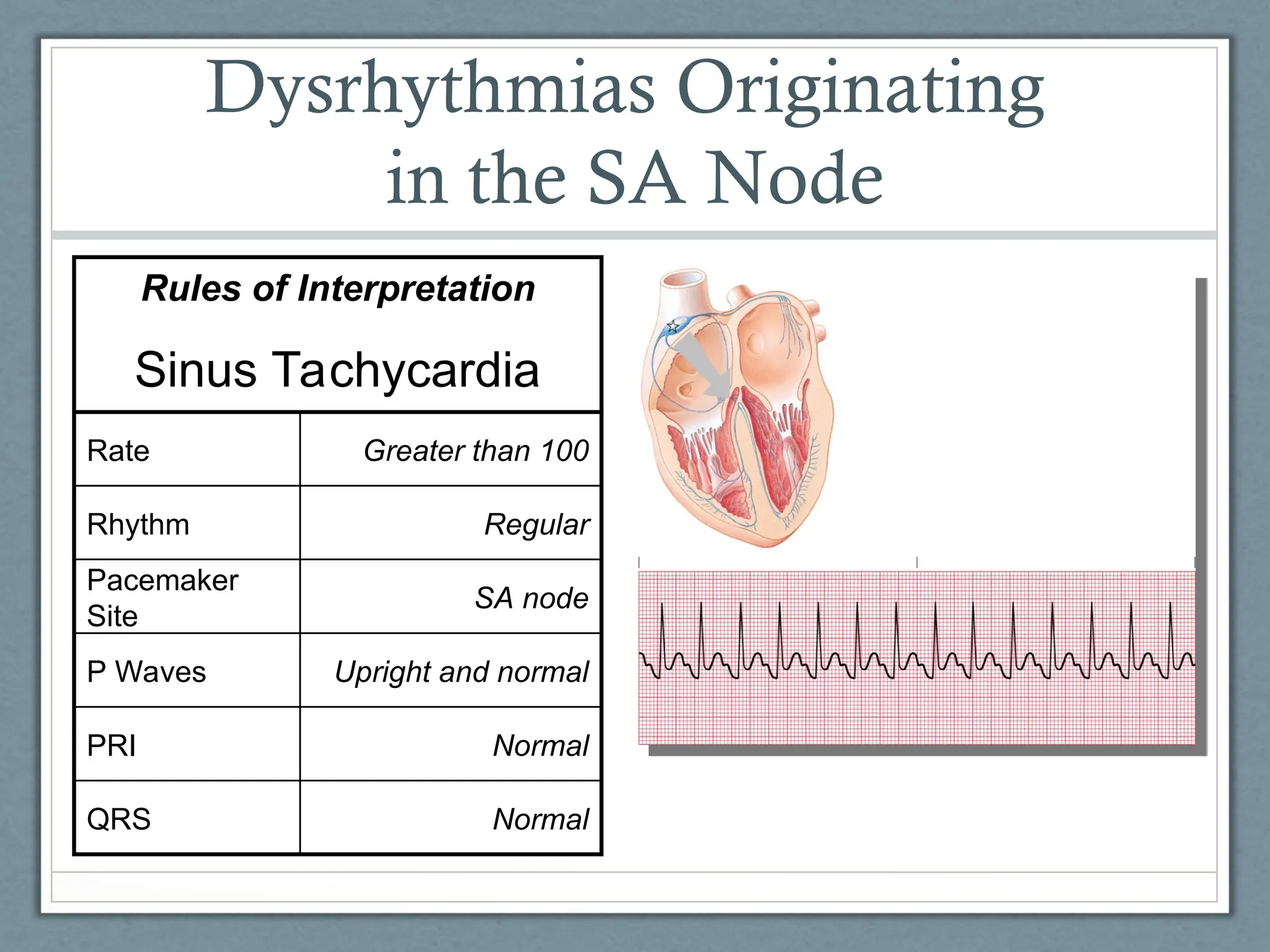 Normal
QRS
Normal
PRI
Upright and normal
P Waves
SA node
Pacemaker
Site
Regular
Rhythm
Greater than 100
Rate
Sinus Tachycardia
Rules of Interpretation
Dysrhythmias Originating
in the SA Node
 