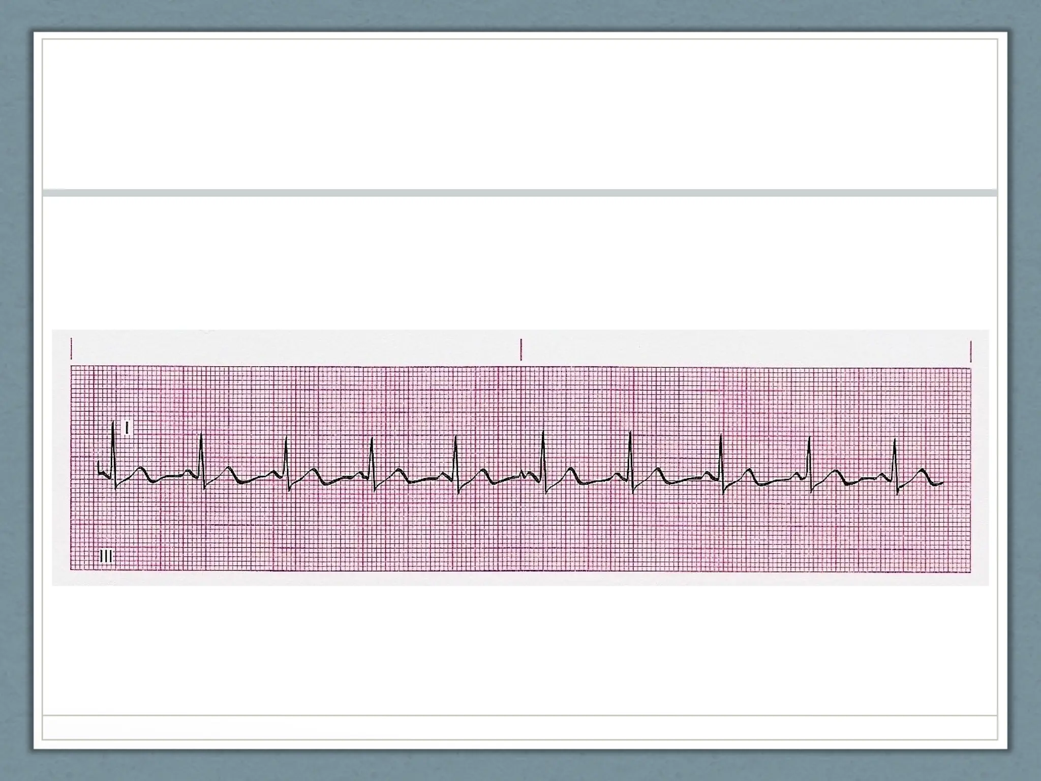EKG POWERPOINT NC emergency care in the streets