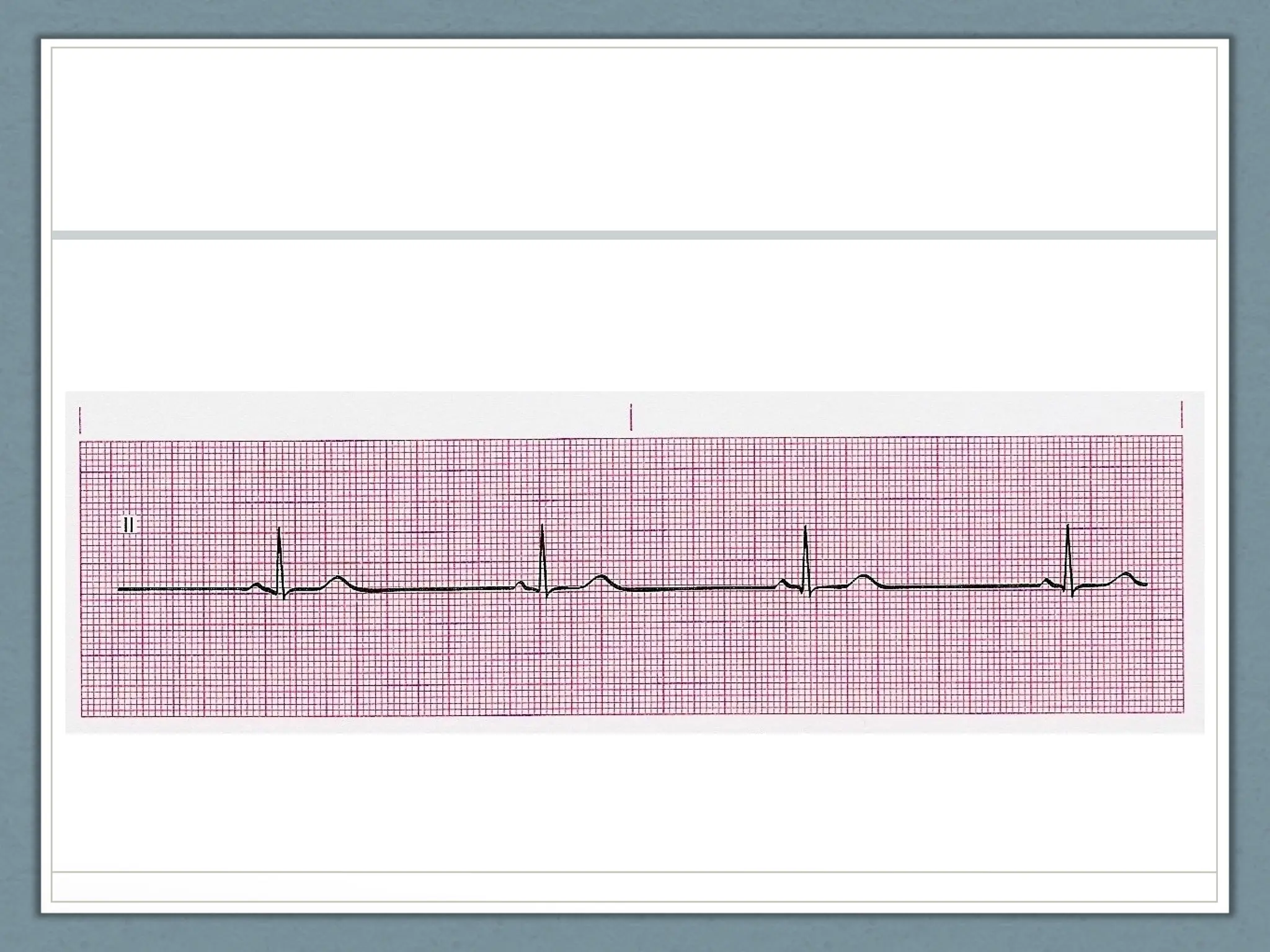 EKG POWERPOINT NC emergency care in the streets
