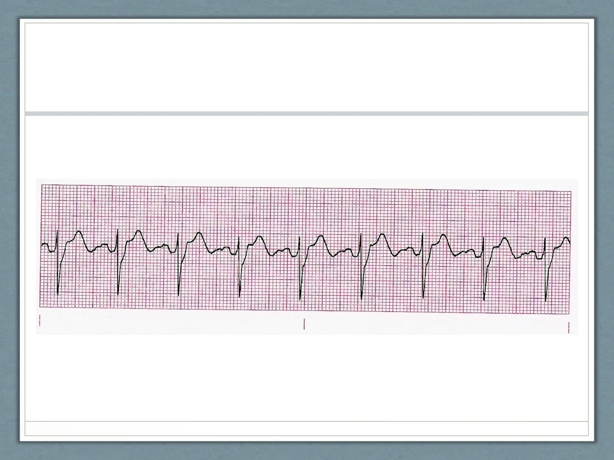 EKG POWERPOINT NC emergency care in the streets