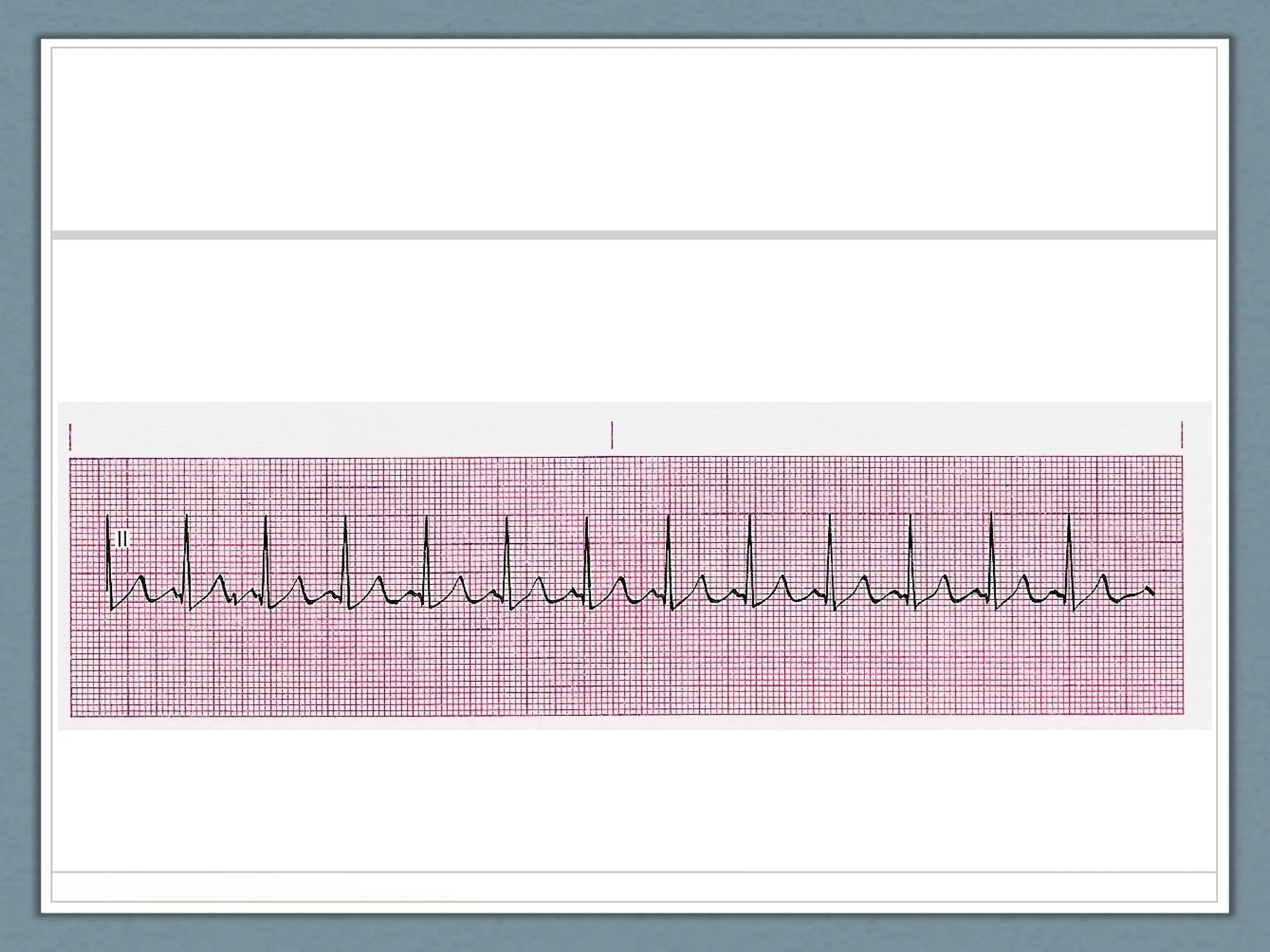 EKG POWERPOINT NC emergency care in the streets