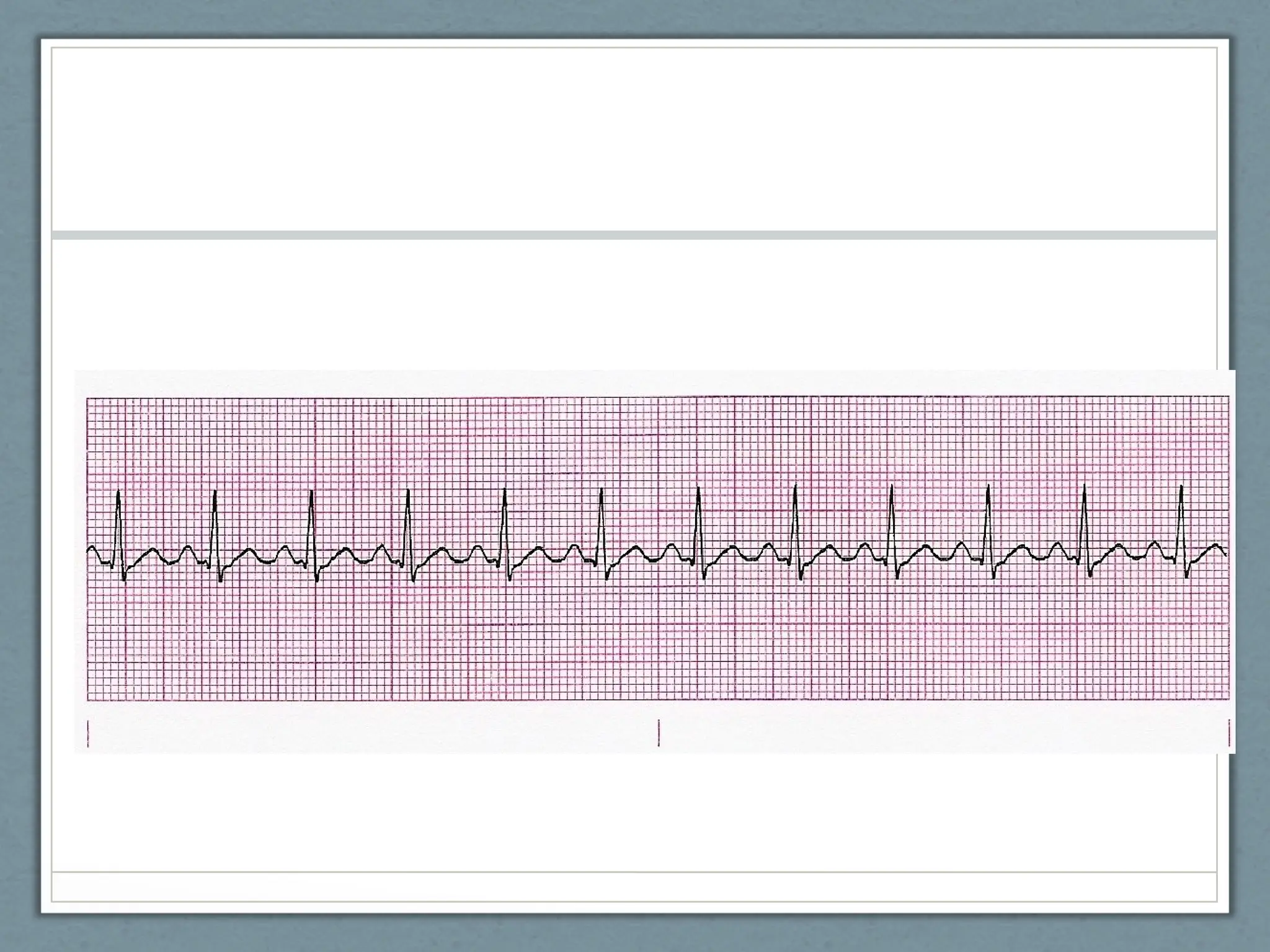 EKG POWERPOINT NC emergency care in the streets