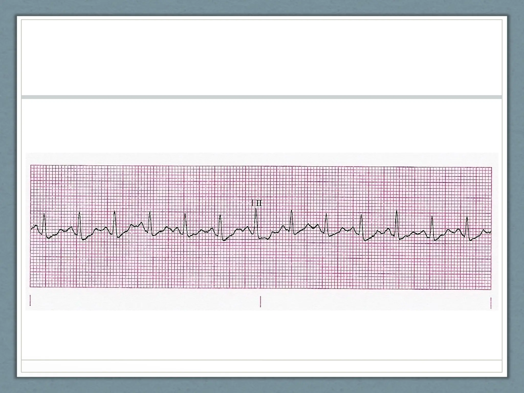 EKG POWERPOINT NC emergency care in the streets