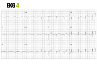 EKG 4
 