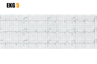 EKG 5
 
