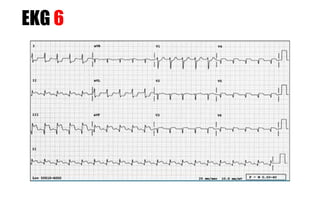 EKG 6
 