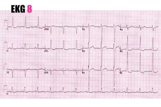 EKG 8
 