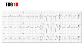 EKG 10
 