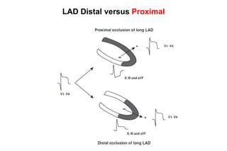 LAD Distal versus Proximal
 